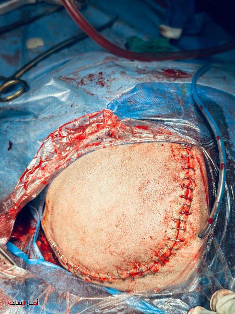 جراحة متطورة تعيد الشكل الطبيعي لجمجمة فتاة باستخدام تقنية الطباعة ثلاثية الأبعاد 1 akhbarelsaa.com qfqywGTt